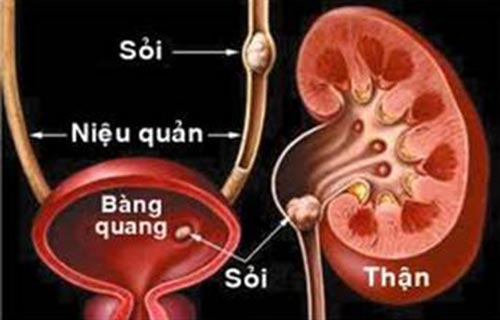 Vị trí sỏi bị kẹt Ảnh: V.H