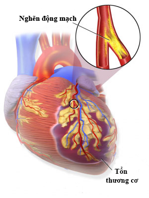 Minh họa t&igrave;nh trạng nhồi m&aacute;u cơ tim Ảnh: MEDICAL XPRESS