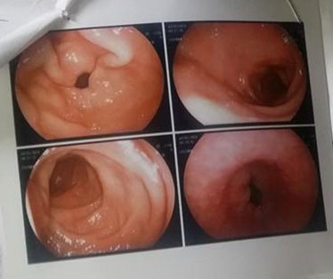 Hình ảnh nội soi dạ dày của chị Vũ Hồ Điệp