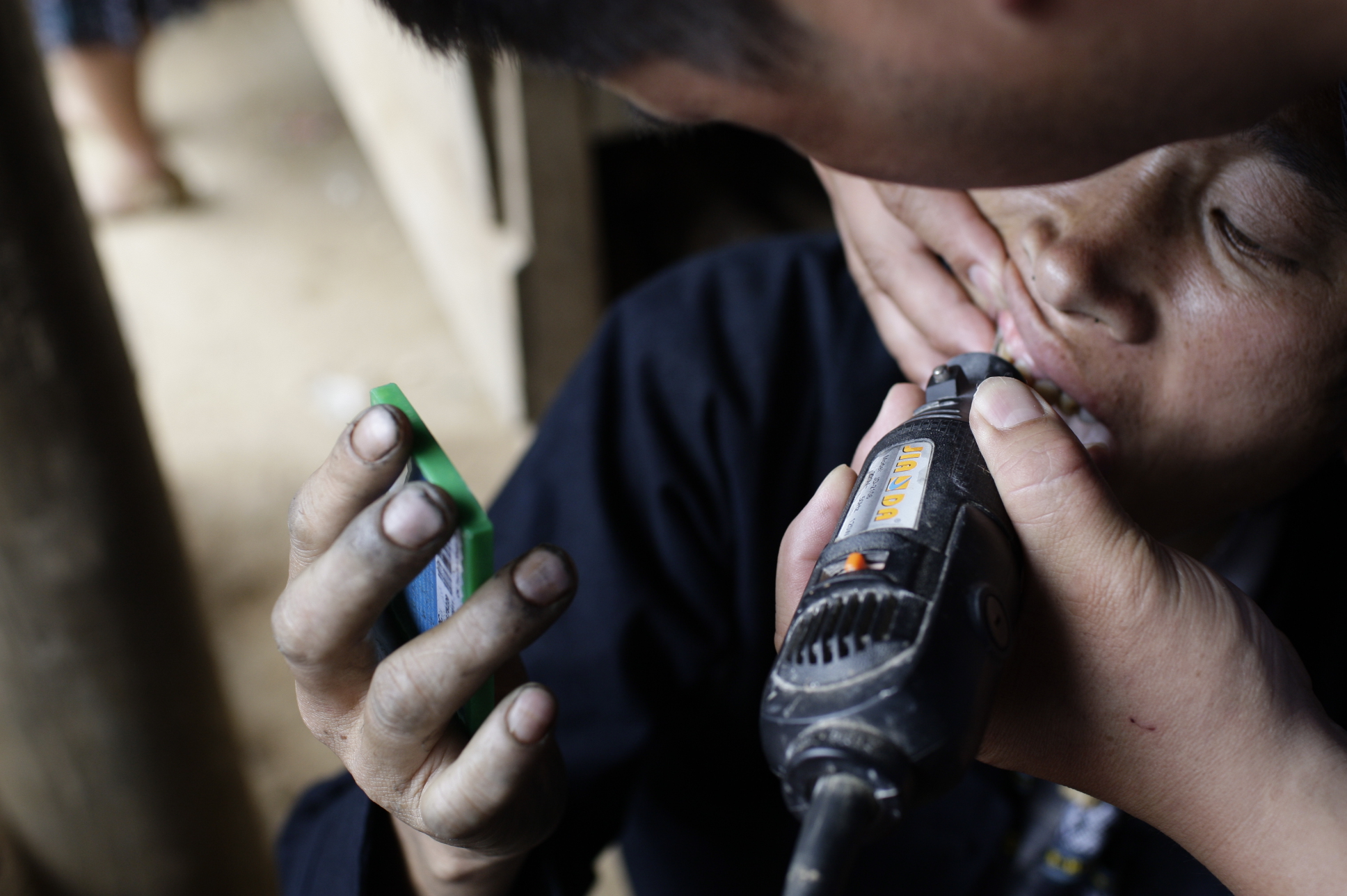 Chỉ sau khoảng 15 ph&uacute;t kh&aacute;ch h&agrave;ng đ&atilde; c&oacute; những chiếc răng mới