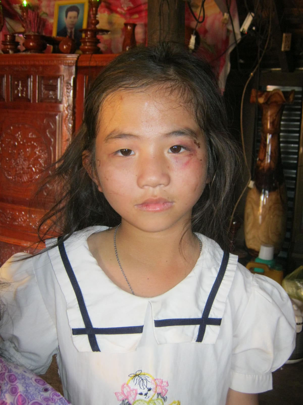 
	B&eacute; Th&uacute;y với những vết thương tr&ecirc;n khu&ocirc;n mặt