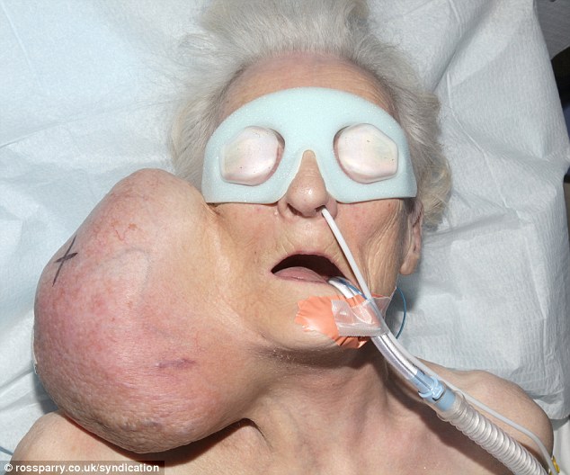 B&agrave; Joyce Haigh, 79 tuổi, với khối u nặng 2kg. Ảnh: Daily Mail
