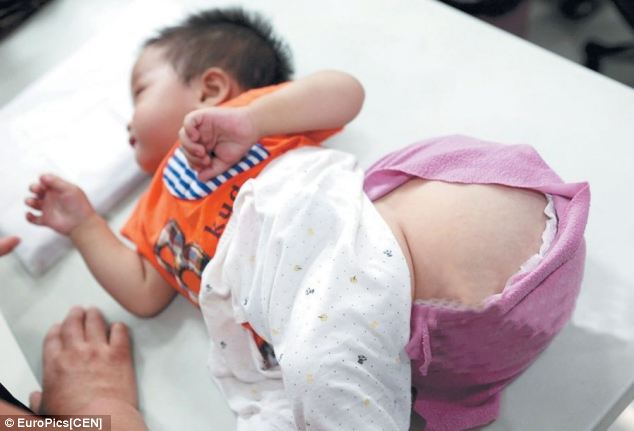 Bé trai mang khối u to bằng quả dưa hấu