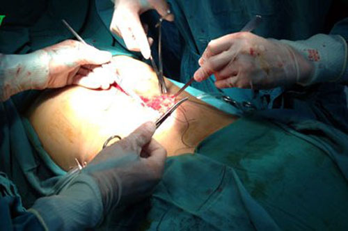 Ca mổ cho bệnh nh&acirc;n Trang A Hỏa bị vỡ gan, vỡ l&aacute; l&aacute;ch, chấn thương lồng ngực v&agrave; g&atilde;y xương đ&ugrave;i