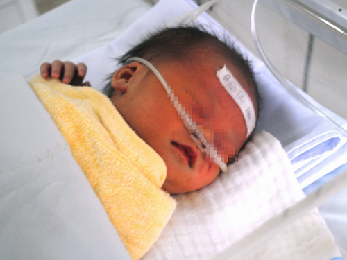 Ch&aacute;u b&eacute; kh&ocirc;ng may bị đẻ rớt xuống bồn cầu đang được chăm s&oacute;c tại Bệnh viện Nhi Thanh H&oacute;a