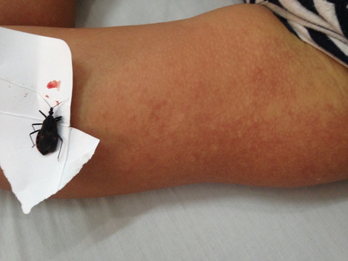 Bệnh nh&acirc;n bị ban đỏ, ngứa to&agrave;n th&acirc;n k&egrave;m theo tăng nhịp tim sau khi bị bọ x&iacute;t h&uacute;t m&aacute;u đốt