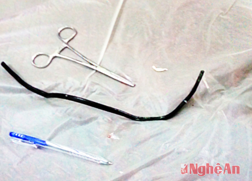 Nuốt dây điện dài 40 cm rồi... quên suốt 2 năm!