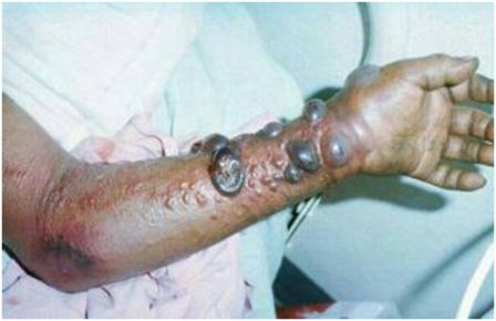 B&agrave;n tay bệnh nh&acirc;n nhiễm virus Ebola