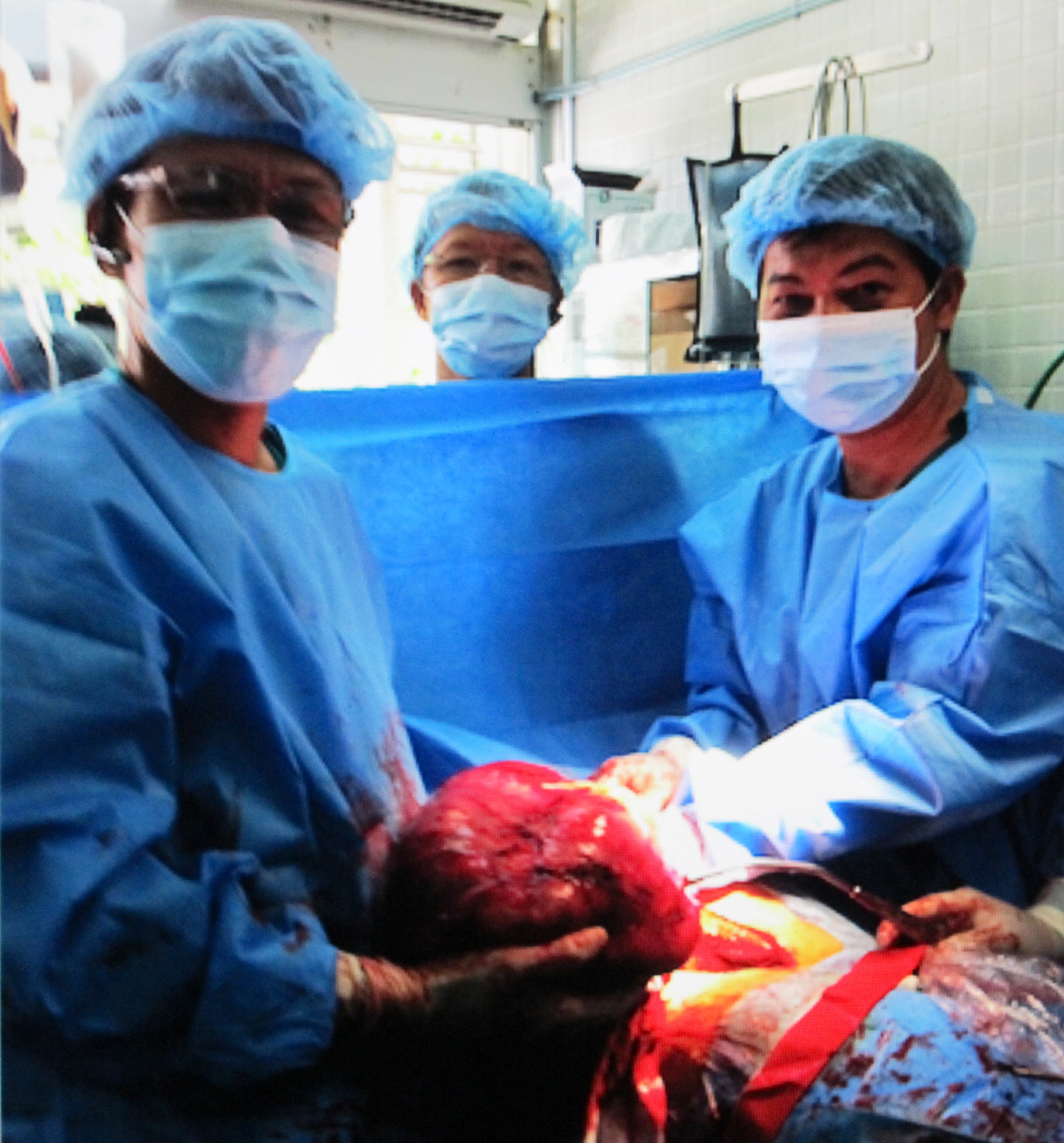 Lấy khối u khổng lồ từ ngực sản phụ