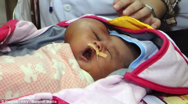 B&eacute; sơ sinh Indonesia mang khối u ở phần mặt b&ecirc;n phải khiến đầu em biến dạng th&agrave;nh h&igrave;nh tr&aacute;i tim