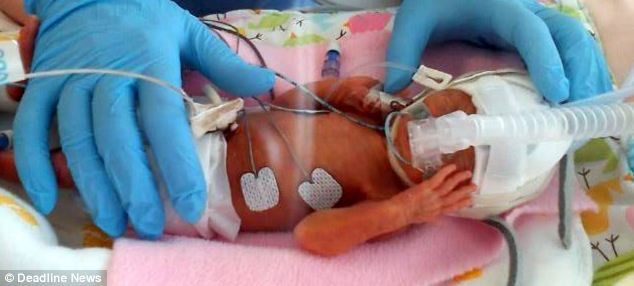 Bé sơ sinh 24 tuần, nặng 538 g