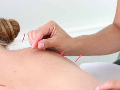 Hiệu quả ch&acirc;m cứu c&oacute; thể k&eacute;o d&agrave;i 3 th&aacute;ngẢnh: MNT