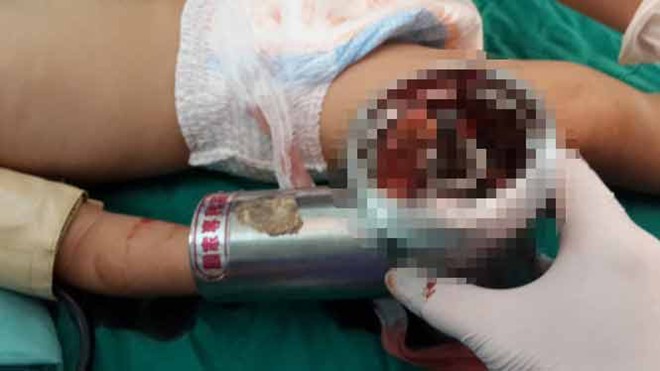 Bé 3 tuổi bị nghiền nát bàn tay trong máy xay thịt