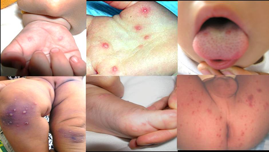 Cảnh báo nguy cơ dịch tay chân miệng gia tăng