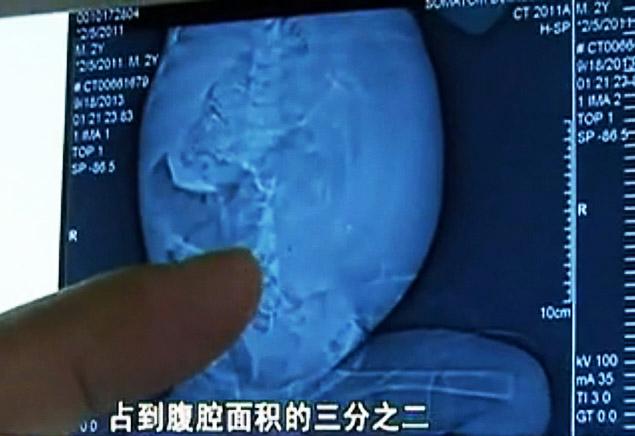 Thai nhi trong bụng Xiao đ&atilde; h&igrave;nh th&agrave;nh xương sống v&agrave; tay ch&acirc;n. Ảnh: v.youku.com