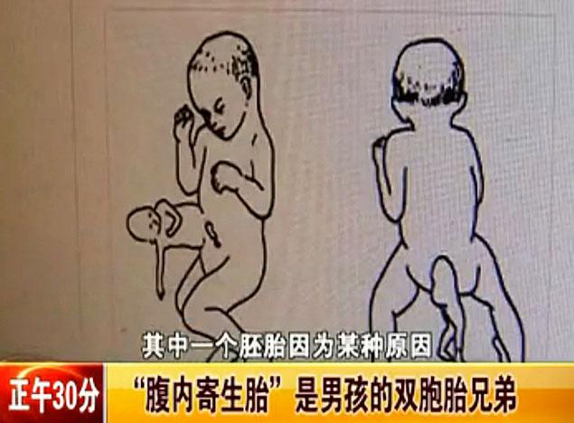 Nếu thai nhi ph&aacute;t triển b&eacute; Xiao c&oacute; thể sẽ mất mạng. Ảnh: v.youku.com&nbsp;