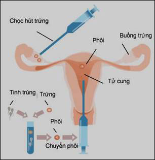 Quy trình thụ tinh trong ống nghiệm