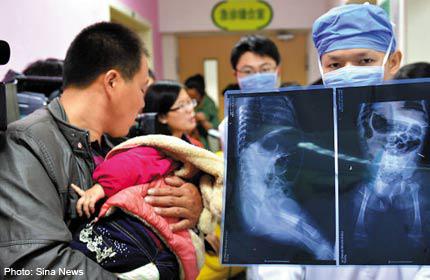 Bé gái bị đâm hàng chục kim tiêm vào cơ thể