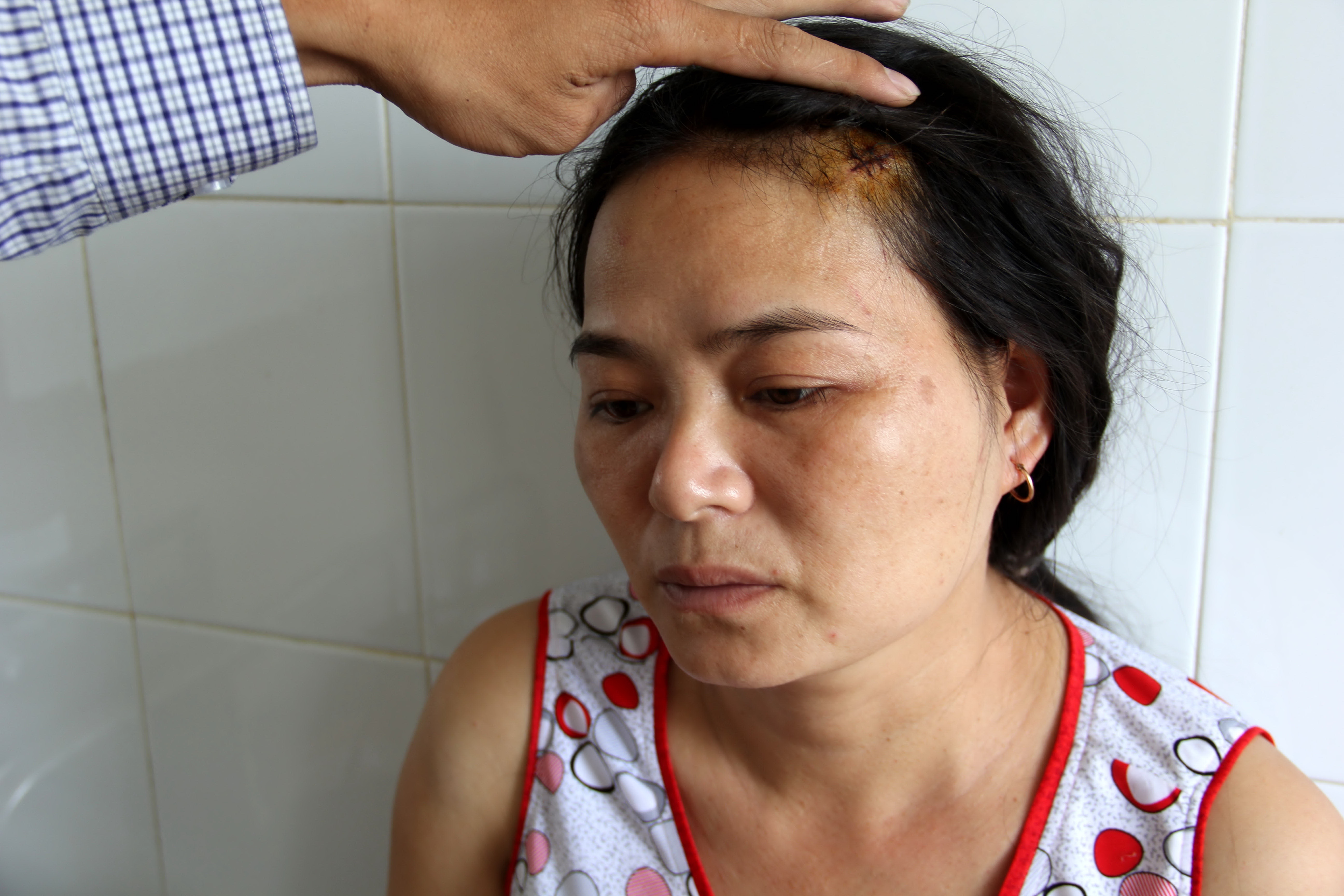 Chị Nguyễn Thị Th&uacute;y tố c&aacute;o bị chồng h&agrave;nh hung khiến thương t&iacute;ch khắp người