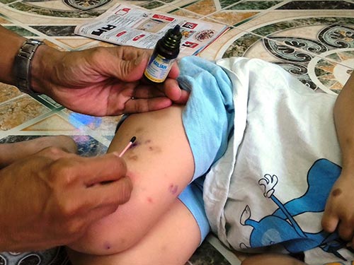Dính nọc độc, cần sơ cứu đúng