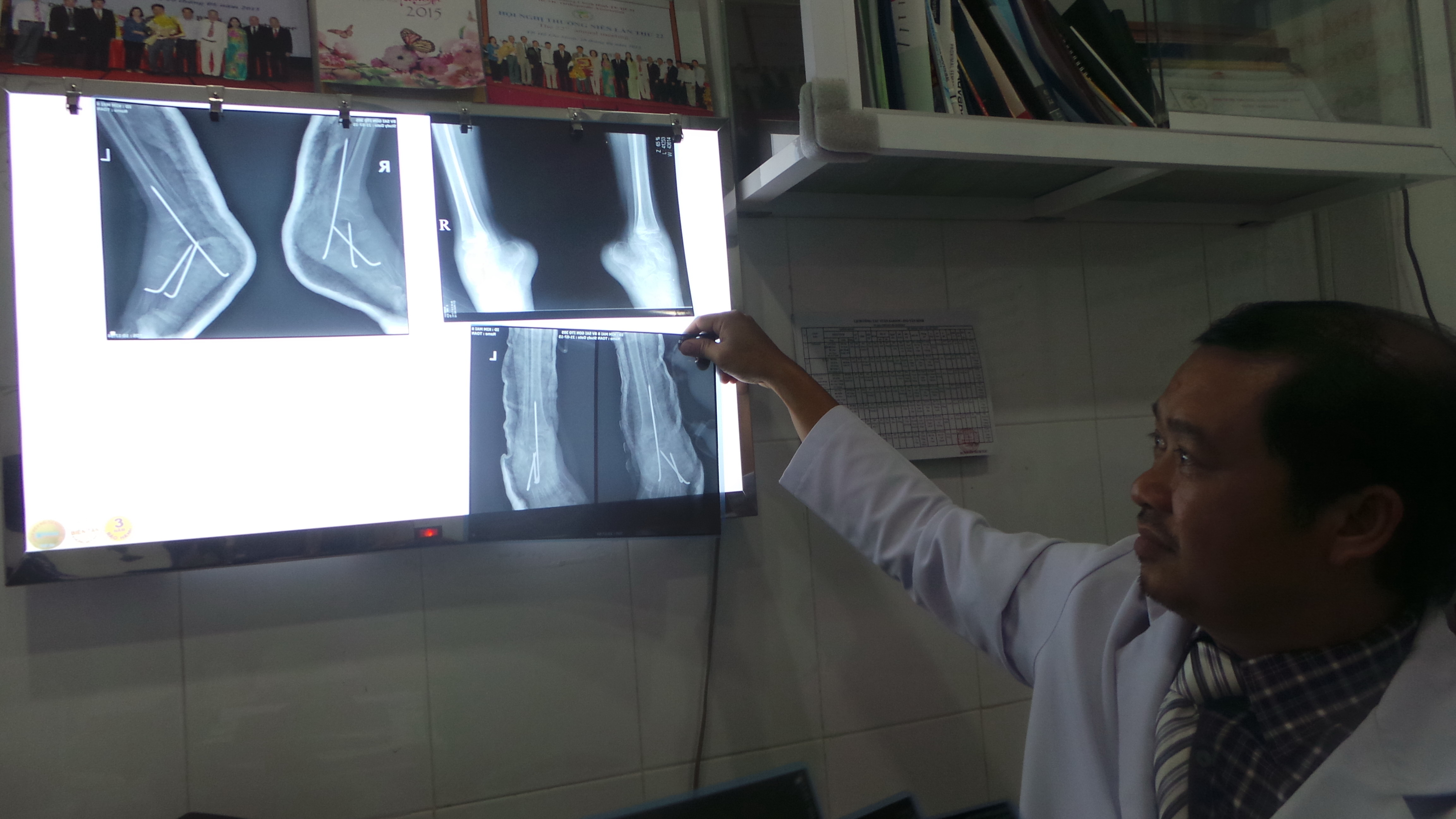 Nhiều chuy&ecirc;n gia hợp sức để phẫu thuật