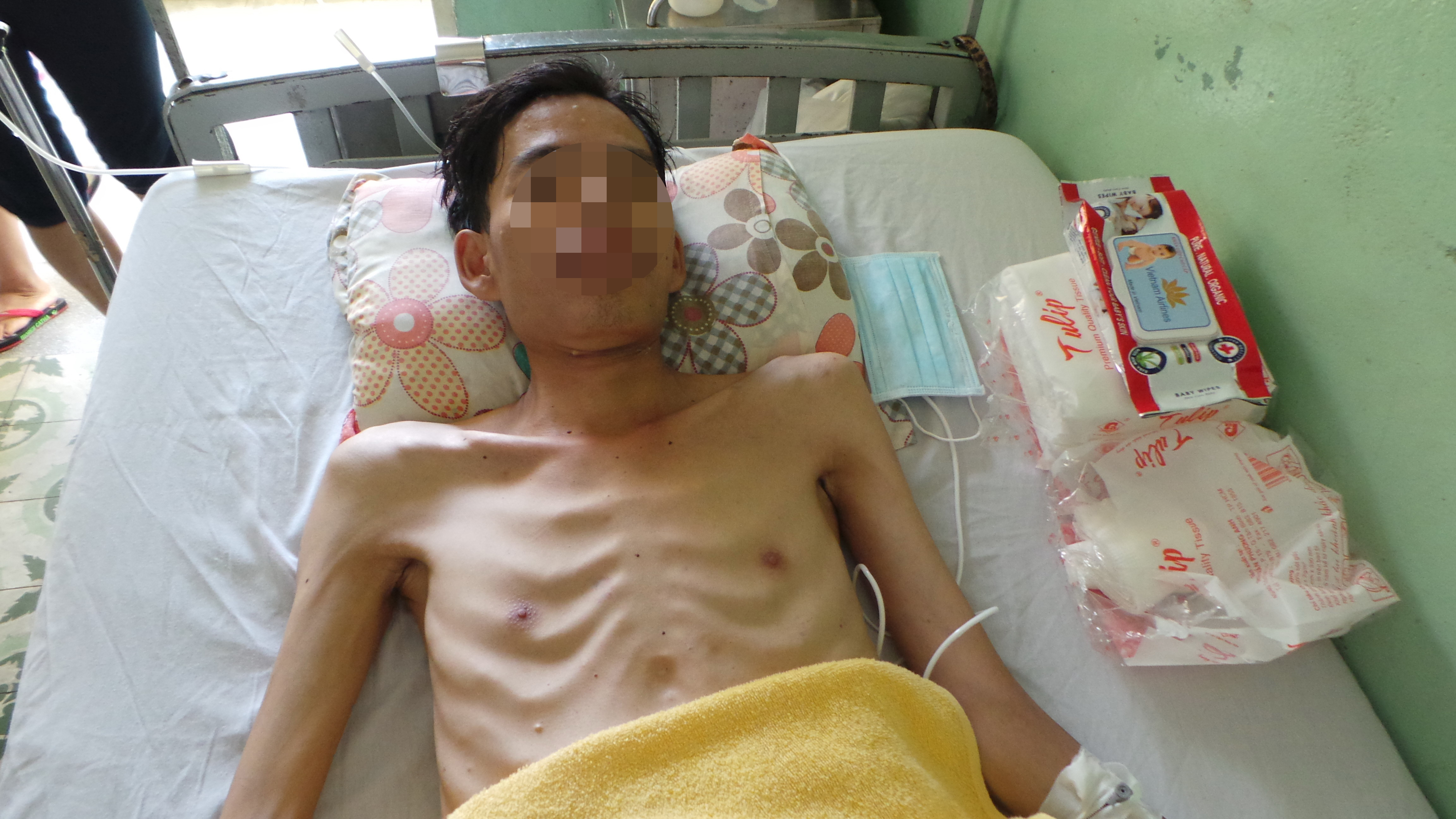 Sau khi được cắt - nối ruột, anh T. đ&atilde; ăn uống được.