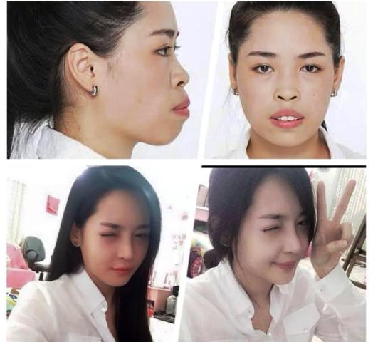 Ảnh Thanh Quỳnh trước v&agrave; sau khi được phẫu thuật thẩm Mỹ. Ảnh: Facebook Vũ Thanh Quỳnh