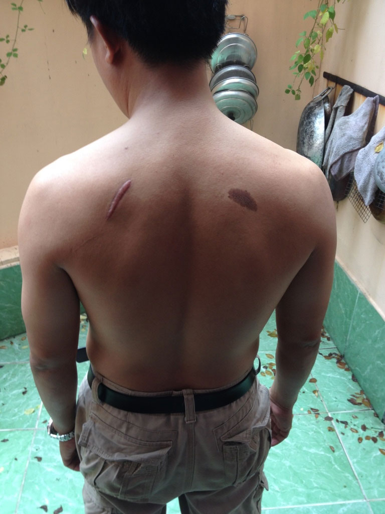 &Ocirc;ng L&ecirc; Văn C&ocirc;ng với vết ch&eacute;m tr&ecirc;n lưng