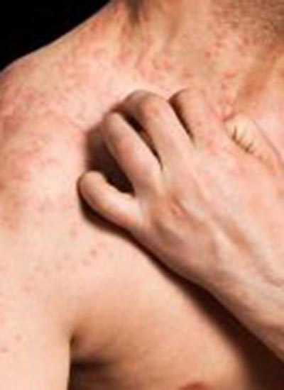 Bệnh chàm làm tăng nguy cơ bệnh tim, đột quỵ