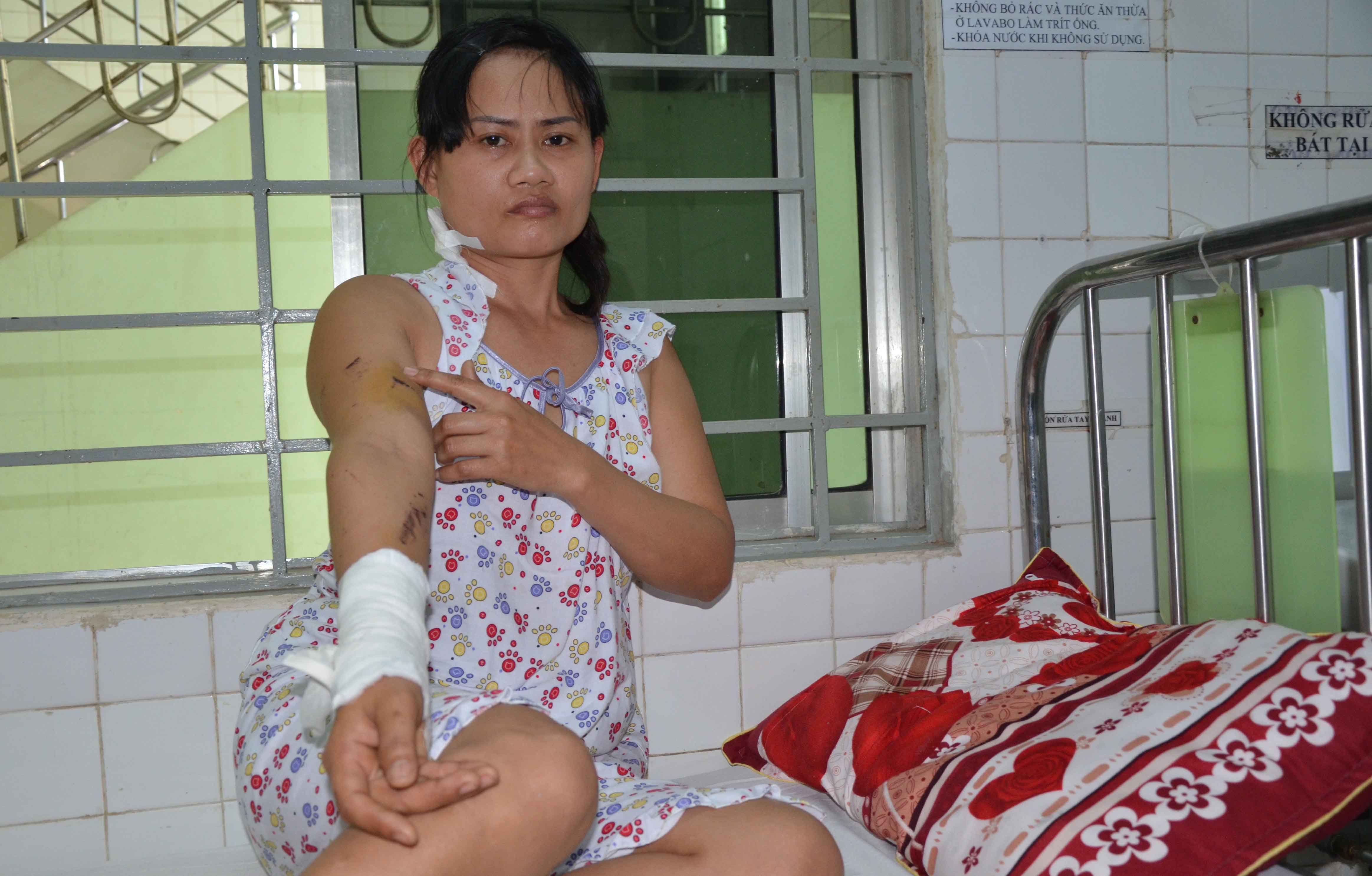 Chị Kế bị nhiều vết bỏng do ph&aacute;o hoa bắn tr&uacute;ng