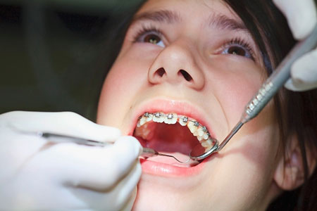 Bé gái rách môi do dụng cụ niềng răng