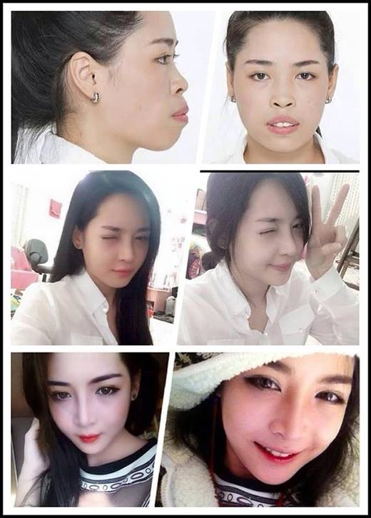 Lột xác nhờ dao kéo: Khó xử