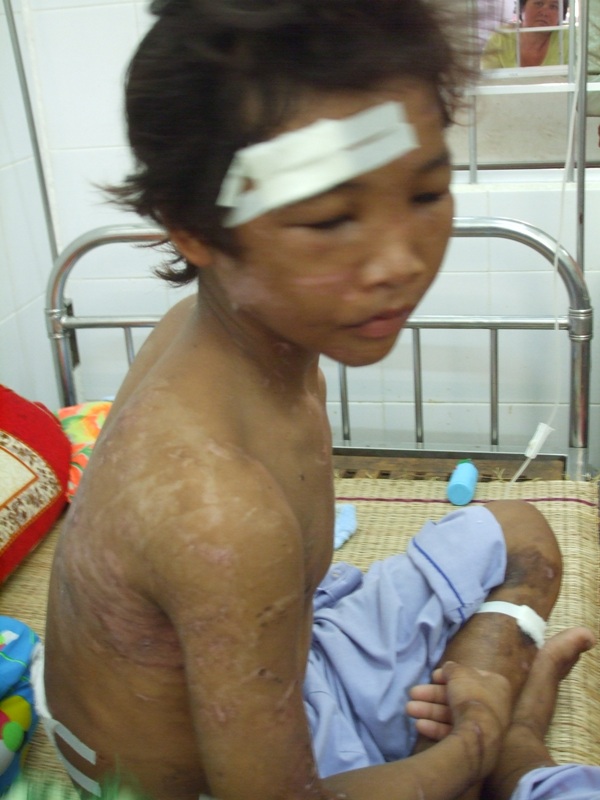 Hào Anh lúc vừa được giải thoát khoải trại tôm giống Minh Đức