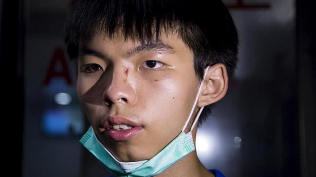 Những vết thương tr&ecirc;n mặt Joshua Wong... Ảnh: Reuters
