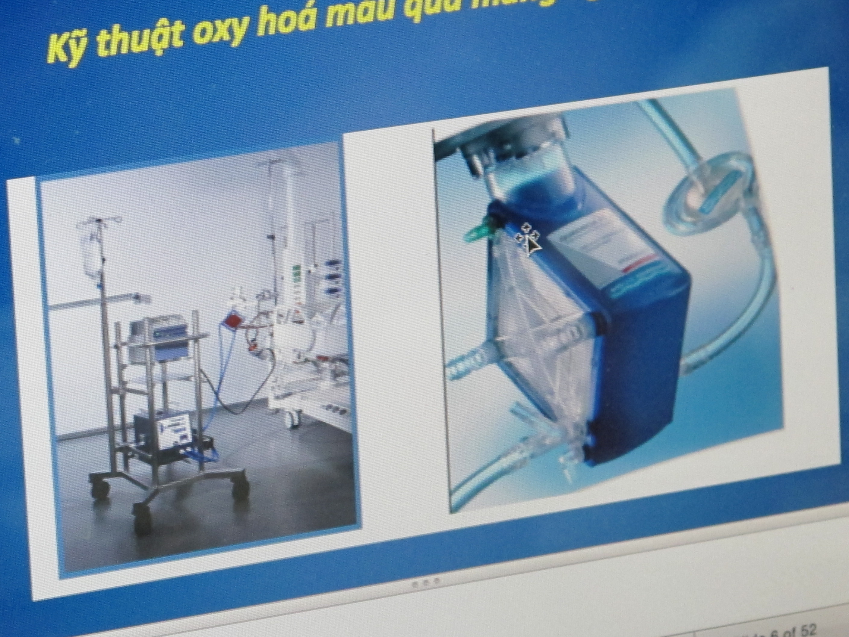 Máy h&ocirc;̃ trợ phương pháp ECMO cho người sắp ch&ecirc;́t