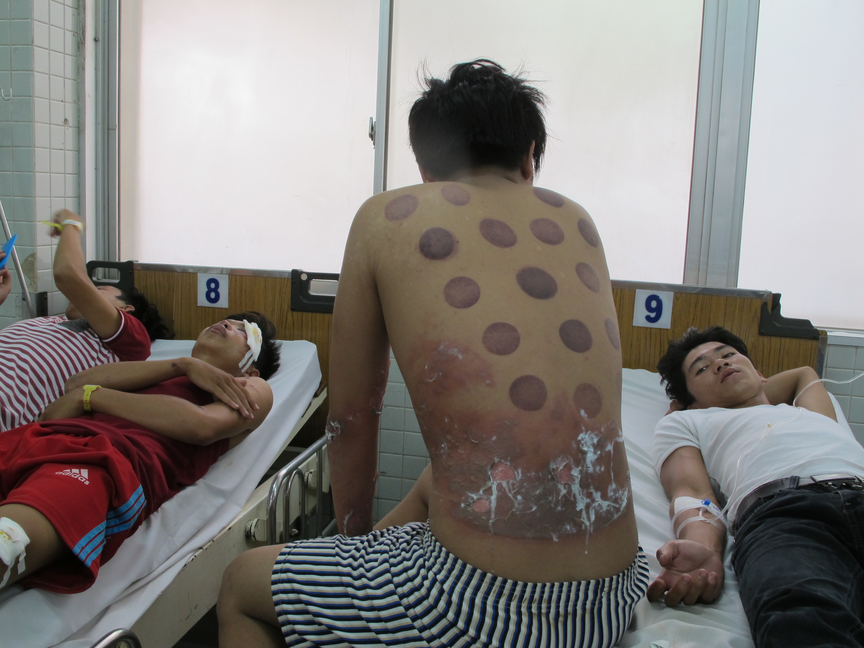 Anh H&ograve;a bị phỏng nặng v&ugrave;ng lưng do cồn g&acirc;y ra