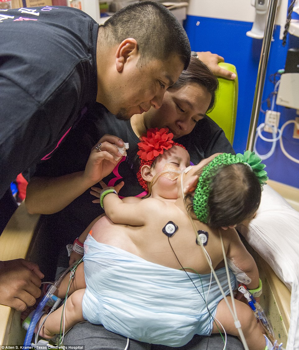 The twins, pictures before the surgery were connected at the chest and abdomen and shared several vital organs including the liver, lungs and intestines