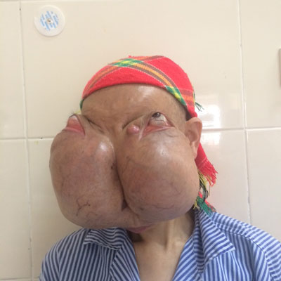 Cắt bỏ 2 khối u khổng lồ trên mặt 1 bệnh nhân