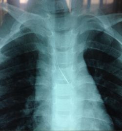 Bé trai bị kim nhọn lọt vào đường thở