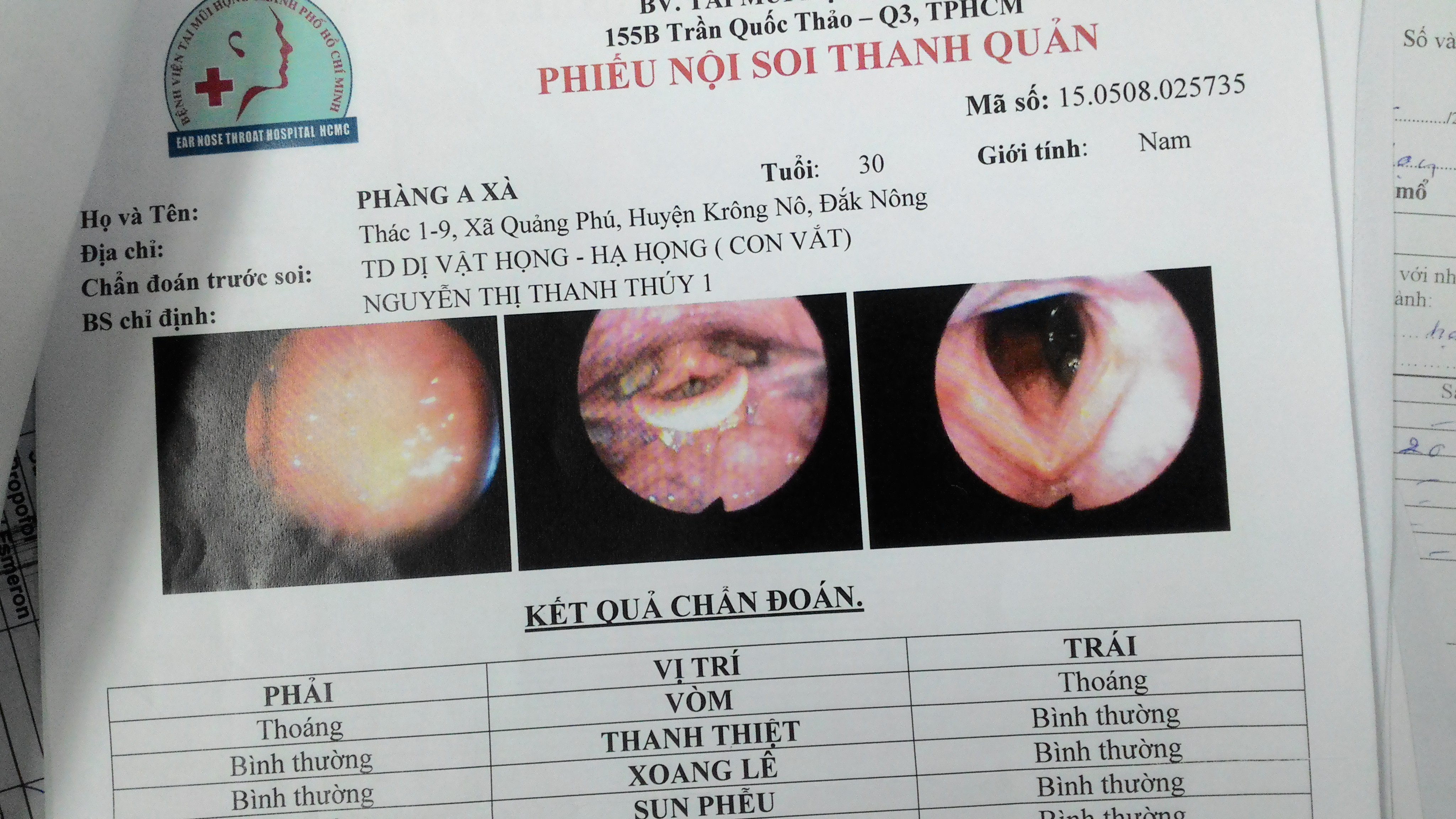 Con đỉa b&aacute;m cuống họng bệnh nh&acirc;n m&agrave; c&aacute;c b&aacute;c sĩ lần đầu mới gặp