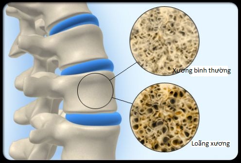 Phát hiện gien liên quan đến loãng xương ở người Việt