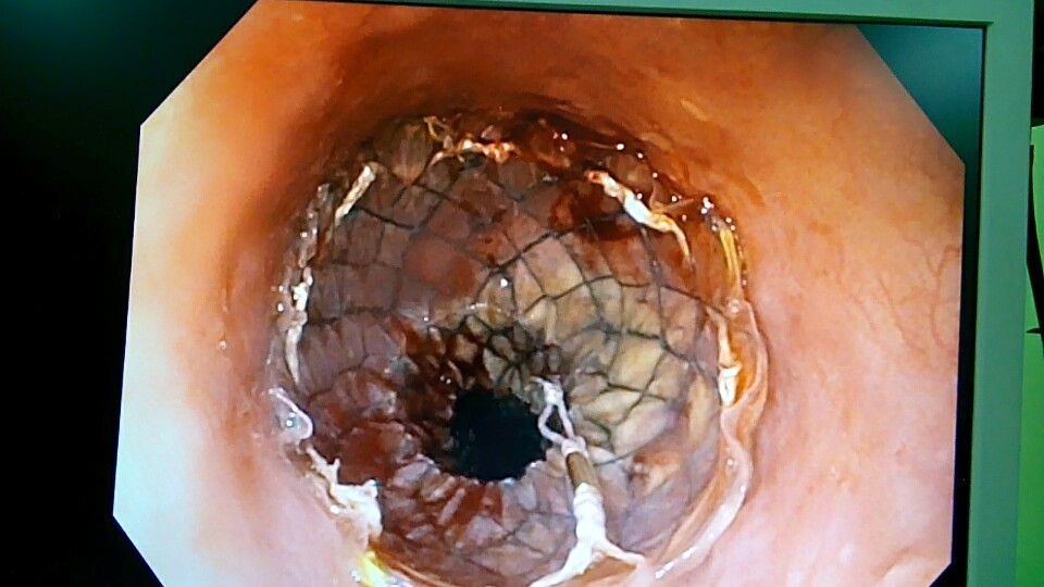 95% biểu hiện khó nuốt là ung thư thực quản.
