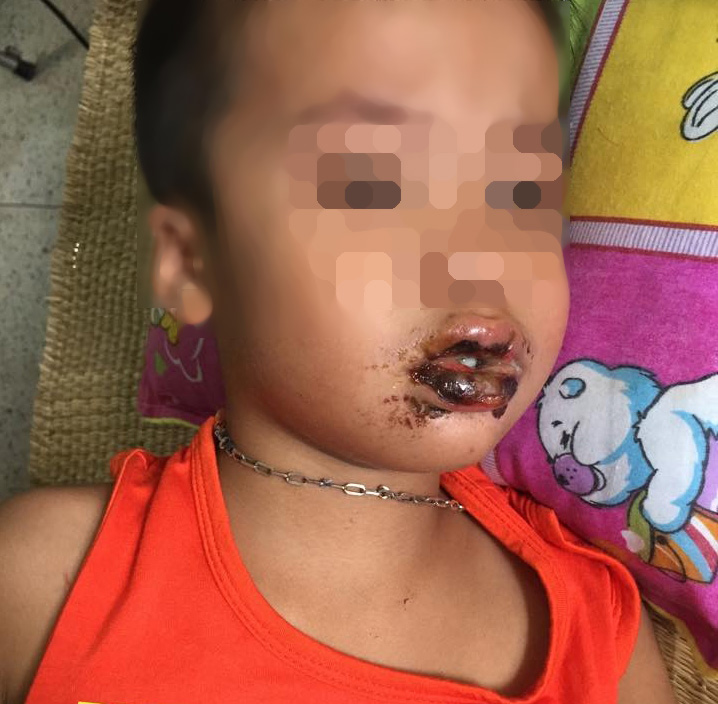 Ch&aacute;u H. đang được theo d&otilde;i v&agrave; điều trị sau khi ăn nhầm phải bột th&ocirc;ng bồn cầu
