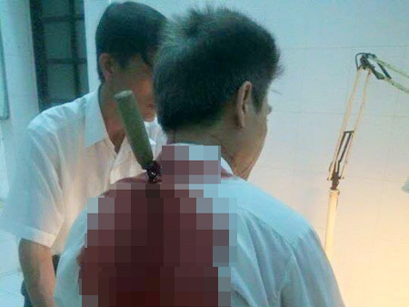 Xe ôm bị cướp đâm dao xuyên gáy xuống tim