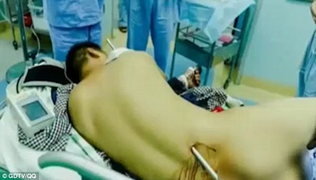 Bị cột thu lôi đâm xuyên qua người vẫn sống