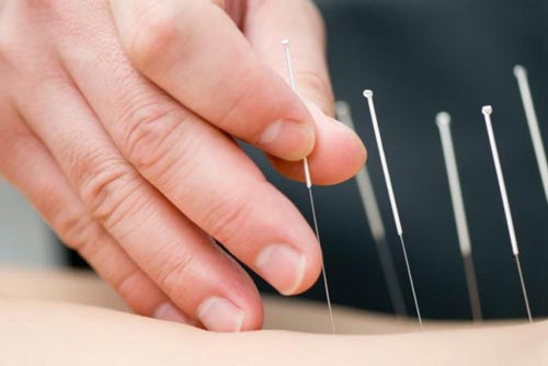 Châm cứu chữa trị triệu chứng mãn kinh