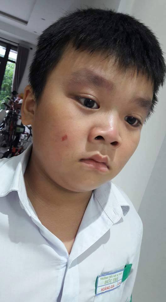 Cô giáo làm xước má học sinh bị phạt 5 triệu đồng