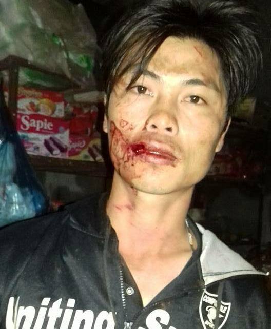
&Ocirc;ng Sang cho rằng bị đ&aacute;nh bầm dập sau khi quay cảnh c&ocirc;ng an x&atilde; chặm xe. Ảnh người d&acirc;n cung cấp
