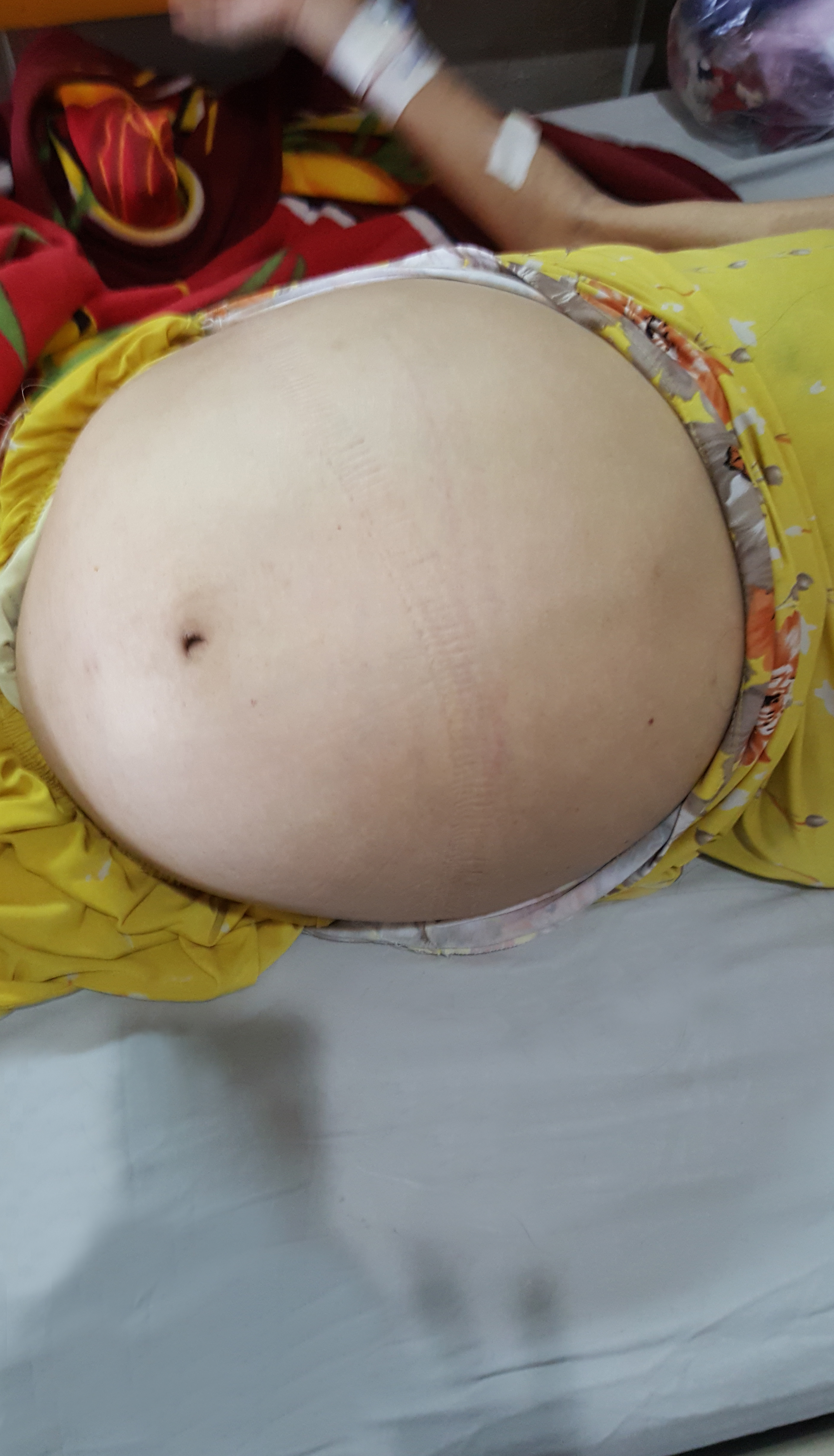Dù thấy bụng to bất thường nhưng bệnh nhân không đi bệnh viện kiểm tra.