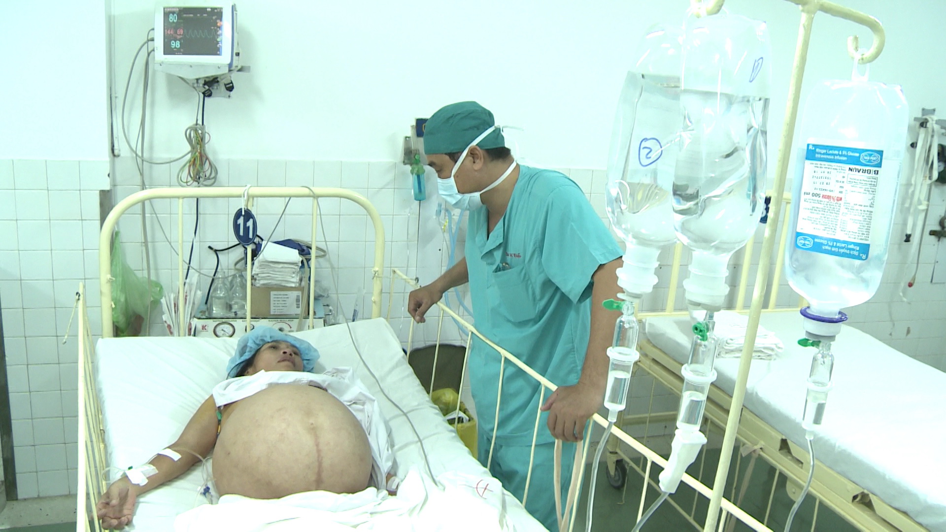 Lấy 12 lít dịch từ bướu buồng trứng khổng lồ